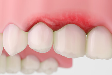 Swollen red gums with inflammation near upper molars.