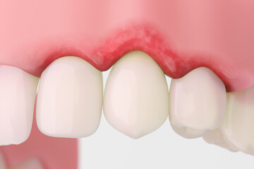 Gingival recession showing exposed tooth roots and receding gums.
