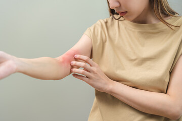 Dermatology asian young woman, girl allergy, allergic reaction from atopic, insect bites on her...