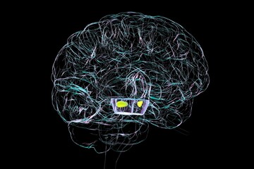 Atrophic substantia nigra in Parkinson's disease, 3D illustration