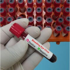 Blood sample for Bleeding Eye Virus test, Marburg virus. Deadly infected virus.