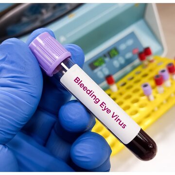 Blood sample for Bleeding Eye Virus test, Marburg virus. Deadly infected virus.