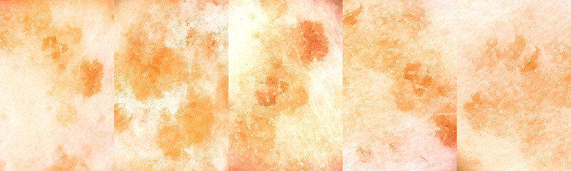 Dermoscopic pattern of solar lentigo. Diagnosis of skin cancer. Prevention. Banner format.