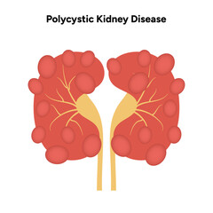 Kidney cysts polycystic urinary disease. Renal cysts of fluid in the kidneys. Medical diagram illustration 