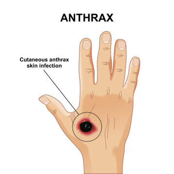 Anthrax skin infection illustration of hand