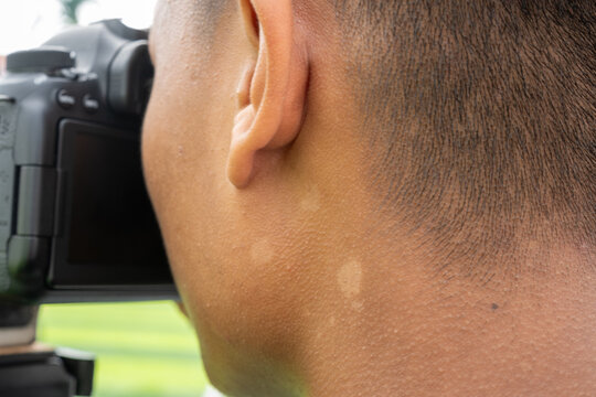 Close-up of a person's ear and neck while holding a DSLR camera with tinea versicolor in pityriasis versicolor, highlighting skin texture and camera detail in an outdoor setting.