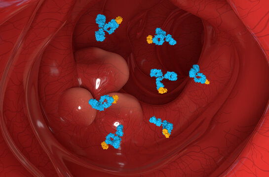 Monoclonal antibody treatment in Colon, Colorectal cancer (CRC) - section view 3d illustration