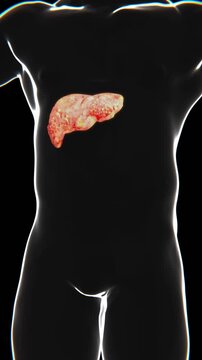 Fatty Liver in Vertical HQ Video | Fatty Liver Disease (NAFLD) Indication in Vertical HD Video
