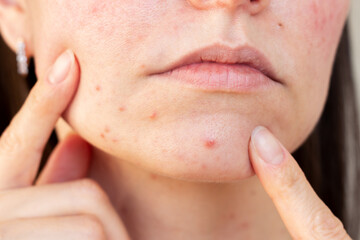 Young brunette Caucasian woman examining the pimples on her chin close up. Girl is experiencing...
