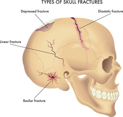 Medical illustration of types of skull fractures, with annotations.