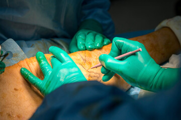 Process of varicose vein surgery in hospital, vein sealing, venous vascular surgery, phlebectomy surgery, surgical field marking, superficial veins problems, swollen skin, step by step
