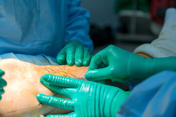 Process of varicose vein surgery in hospital, vein sealing, venous vascular surgery, phlebectomy...