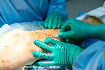 Process of varicose vein surgery in hospital, vein sealing, venous vascular surgery, phlebectomy surgery, surgical field marking, superficial veins problems, swollen skin, step by step