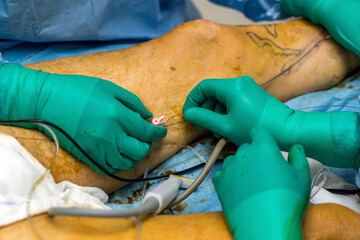 Process of varicose vein surgery in hospital, vein sealing, venous vascular surgery, phlebectomy...