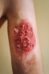Severe Burn Injury on Arm: Medical Image of a Second-Degree Burn