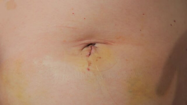 Close Up of a Womans Abdomen After Laparoscopy with Stitches Still in Place