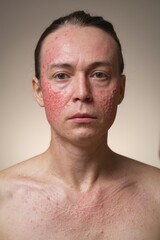 Obraz premium Portrait of a Person with Severe Skin Rash