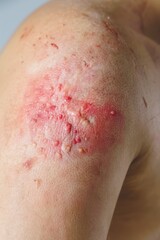Fototapeta premium Severe Skin Injury: A Close-Up View of a Wound