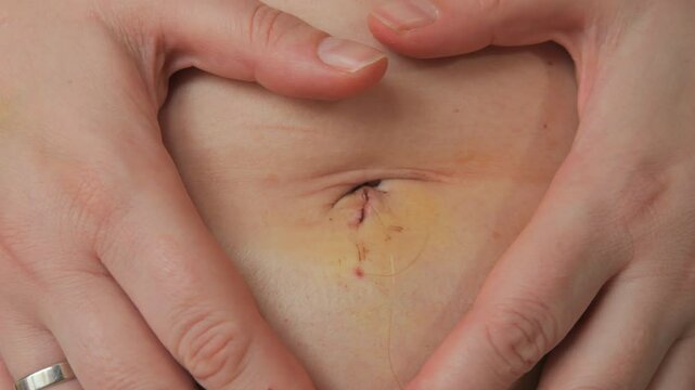 Close Up of a Womans Abdomen After Laparoscopy with Stitches Still in Place