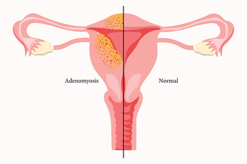Anatomical diagram showing adenomyosis symptoms versus a healthy uterus.