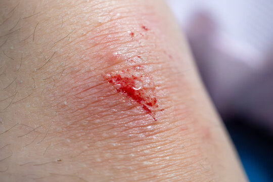 wound on child knee after fall on the ground