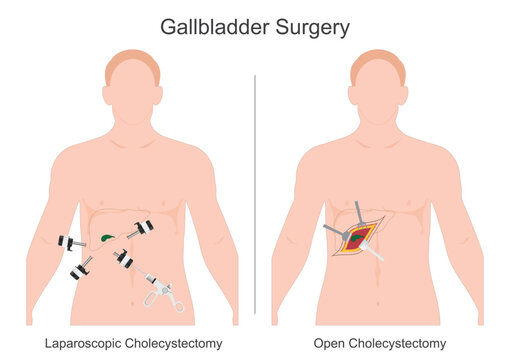 A Cholecystectomy is surgery to remove gallbladder.