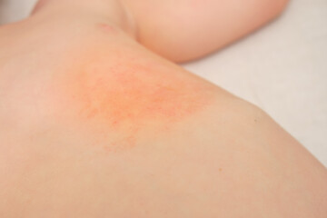 Allergic skin reaction on baby’s chest. Close-up of irritated child skin with redness and rash....