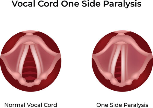 Vocal Cord Paralysis One Side Design Vector Illustration