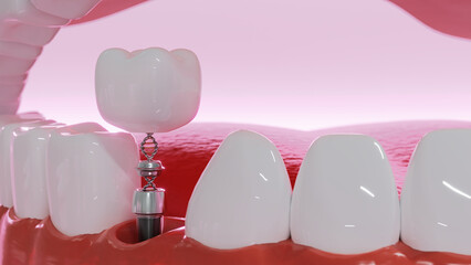 Dental Implants surgery concept, dentistry denture, Dental denture on pink background. 3D render. 