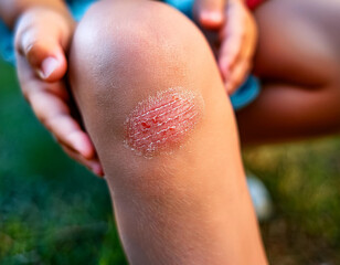 Detailed view of a healing scrape on a child's knee, captured outdoors after playtime.