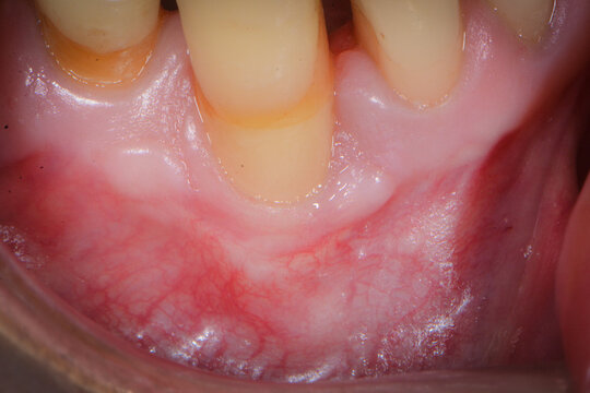 gingival recession on lower canine