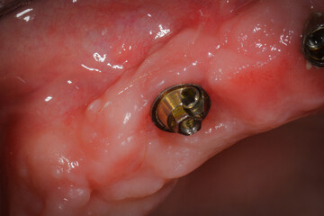 dental implant multi-uniit abutment healthy peri-implant tissue