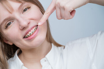 A beautiful red-haired girl smiles and points to the braces. Young woman corrects bite with...