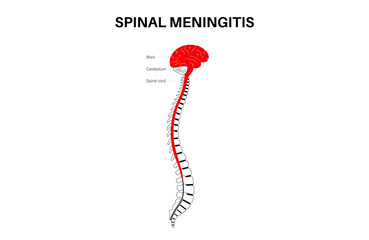 Spinal meningitis poster