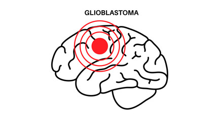 Glioblastoma brain cancer