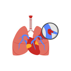 Pulmonary Embolism, Cardiovascular Disease Illustration Icon