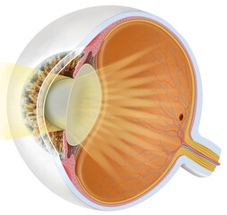 Illustration about ocular cataract, progressive opacification of the lens, causing blurred vision, and decreased visual acuity. Its main treatment is lens extraction surgery.
