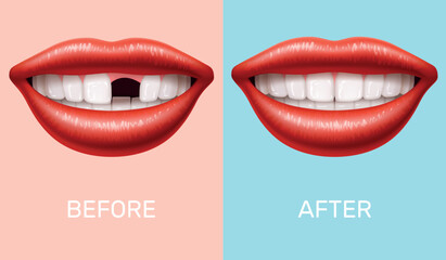 Woman mouth without tooth. Teeth implantation. Realistic woman mouth, smile before and after. Prosthetics in stomatology clinic. Dental medicine, molar 3d isolated vector healthcare concept