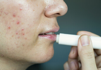 Woman applying lips balm to her lips.  Closeup of lip protection