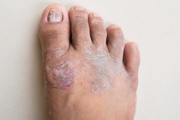 An overhead close-up of a foot with a fungal infection. The skin has red patches, some peeling, and...