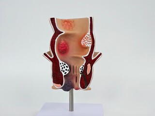 Model of unhealthy lower rectum with inflamed vascular structures. Problem of hemorrhoids