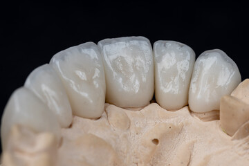 Dental health care. Ceramic zirconium in final version. Close up dental zircon ceramic crowns on...
