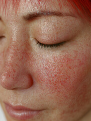 Fototapeta premium Close-up of a woman's face showing signs of eczema with vibrant red hair in a natural setting