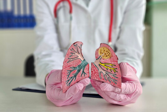 Lung cancer, asthma, chronic obstructive pulmonary disease or COPD, bronchitis, emphysema concept