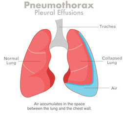 Pneumothorax, air in the lungs or collapsed lung.   Pleural effusions, respiratory system diseases. Vector illustration