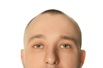 Fototapeta premium Baldness problem. Man with receding hairline on white background, closeup