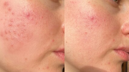Before and After Acne Treatment: Visible Skin Healing & Transformation, Blemish Reduction, Smooth &...