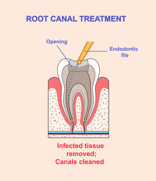 Root canal treatment infographics. Infected tissue removed. Dentistry and stomatology. Healthcare and medicine. Poster or banner. Flat vector illustration isolated on beige background