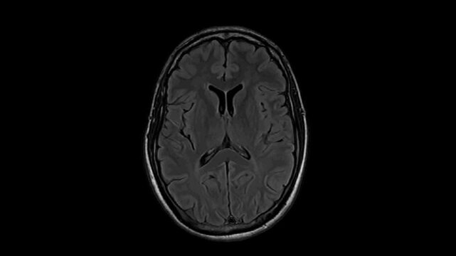 MRI examination of the brain. Axial T2-weighted fluid-attenuated inversion recovery pulse sequence. Series description: Ax T2 FLAIR