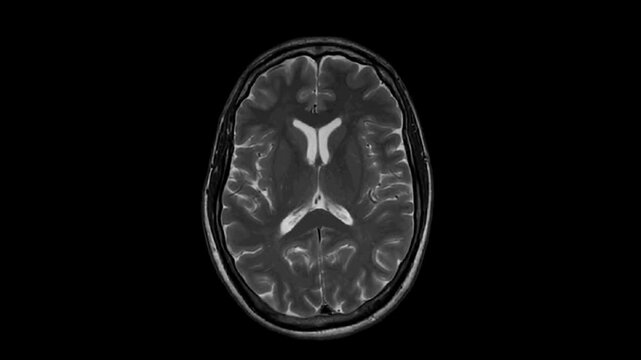 MRI examination of the brain.  Axial T2-weighted FSE (fast spin echo) images of the brain.  